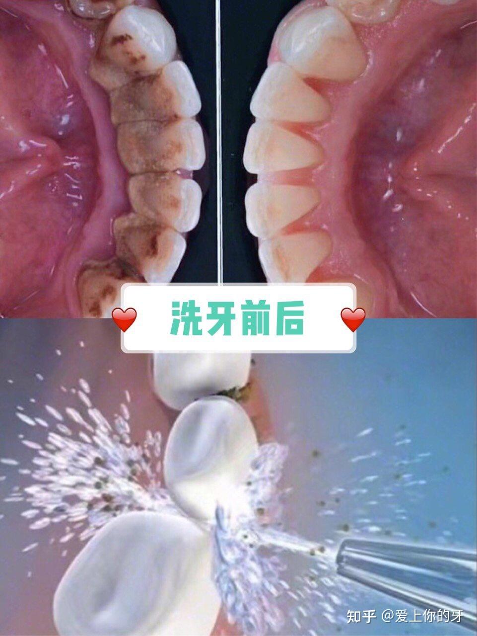 潮州洗牙可以用医保吗(洗牙可以用医保吗,报销比例多少)